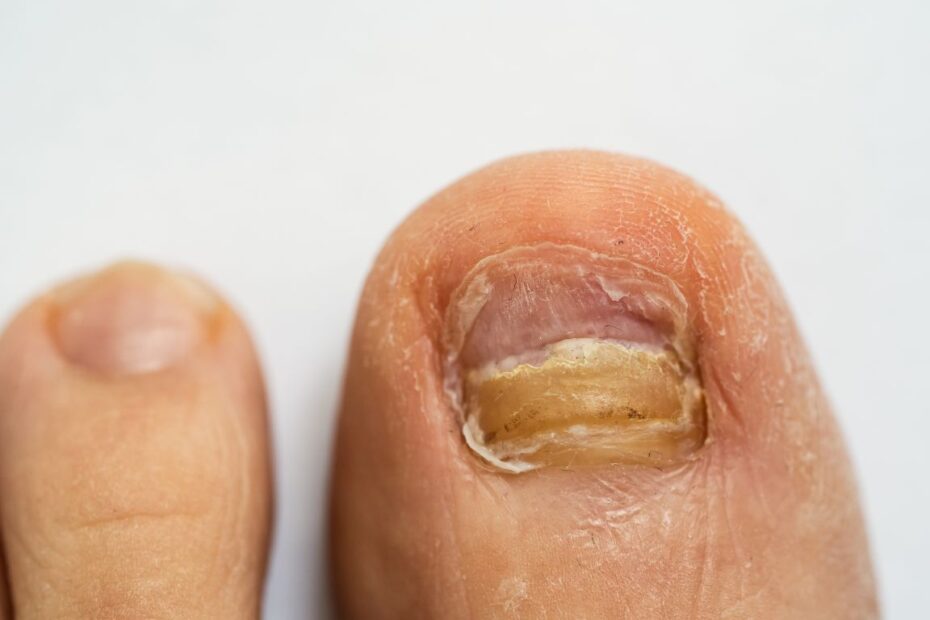 Tribiotic na grzybicę paznokci