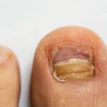 Skinatrin na grzybicę paznokci – czy warto stosować ten lek? Skinatrin na grzybicę paznokci