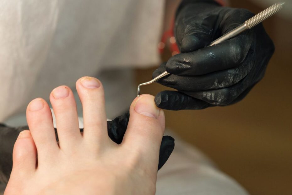 Wrastający paznokieć jak wyciąć