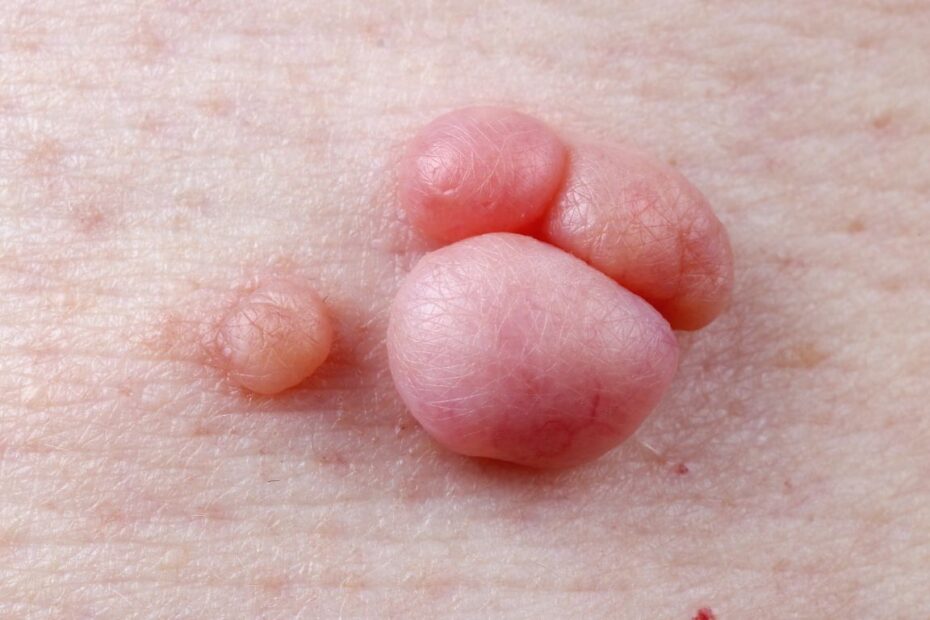 Co na kurzajki u dzieci