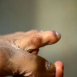 Odcisk między palcami u nóg – jak go rozpoznać i usunąć? Odcisk między palcami u nóg