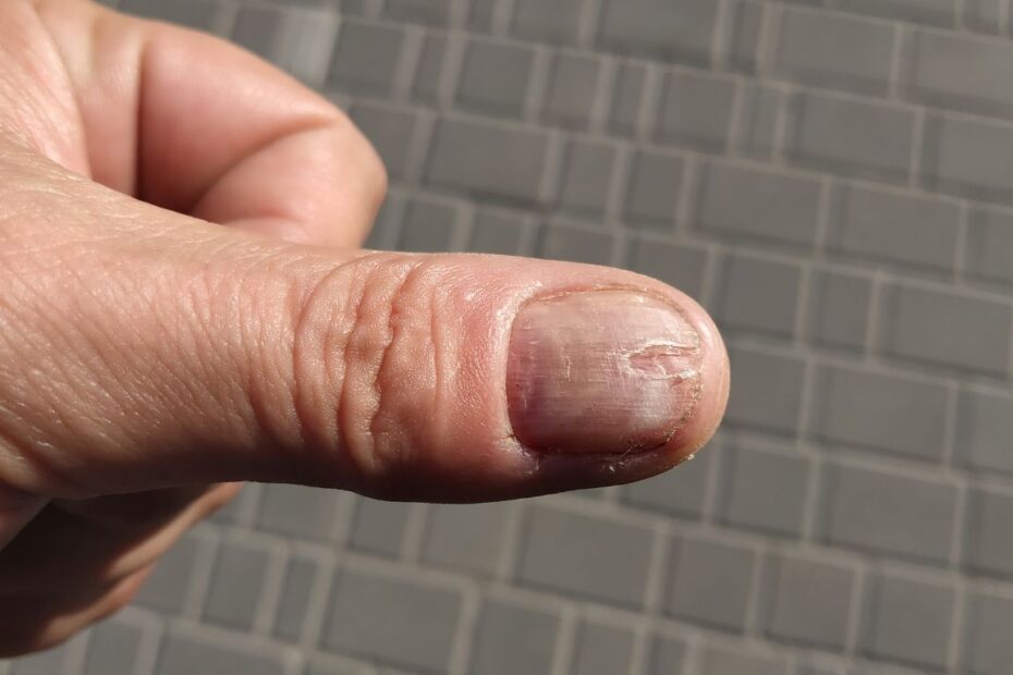 Jak wygląda grzybica paznokci