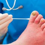 Maść na grzybicę paznokci – które preparaty są najskuteczniejsze? Maść na grzybicę paznokci