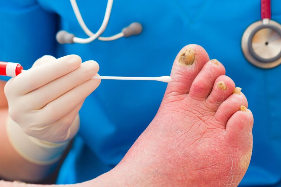 Maść na grzybicę paznokci