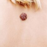 Kurzajka czarne korzenie