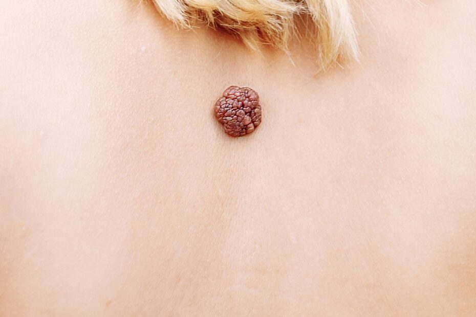 Kurzajka czarne korzenie