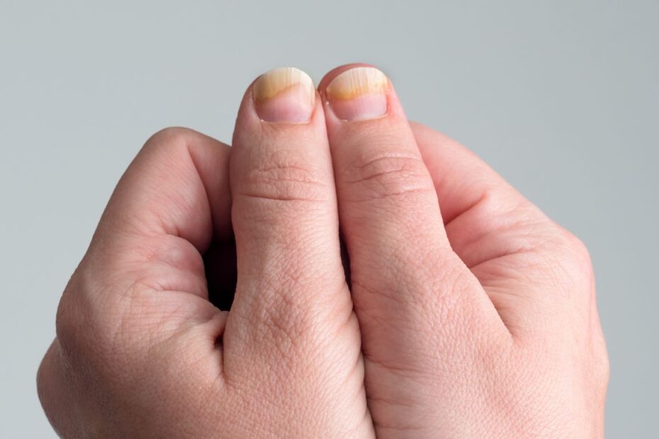 Laserowe leczenie grzybicy paznokci