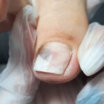 Steper pro na grzybicę paznokci