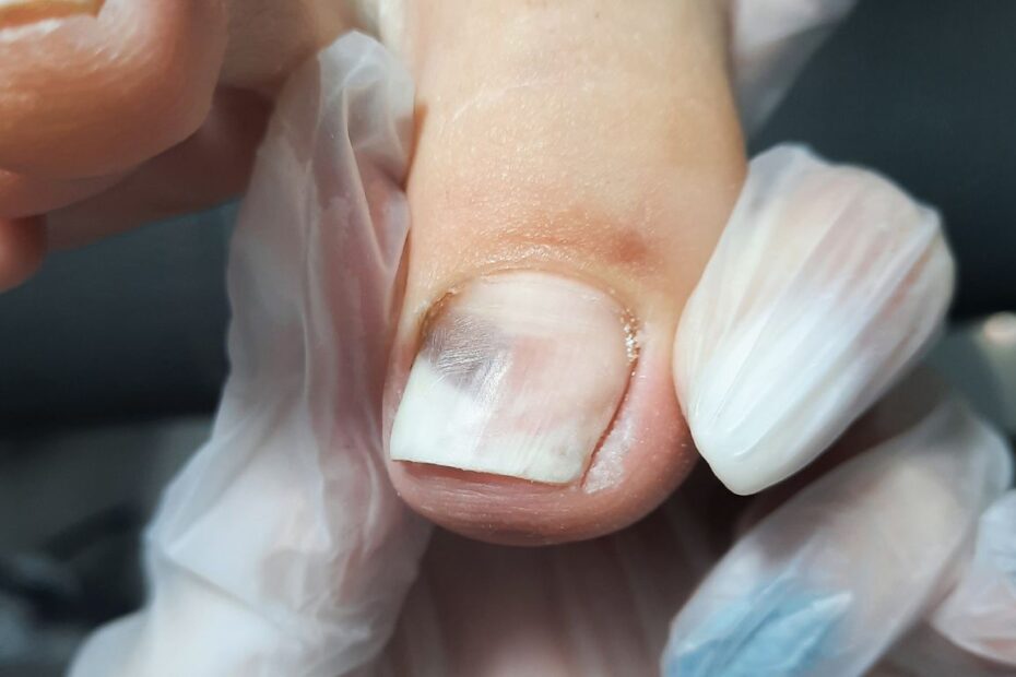 Steper pro na grzybicę paznokci