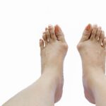 Co na bolące haluksy