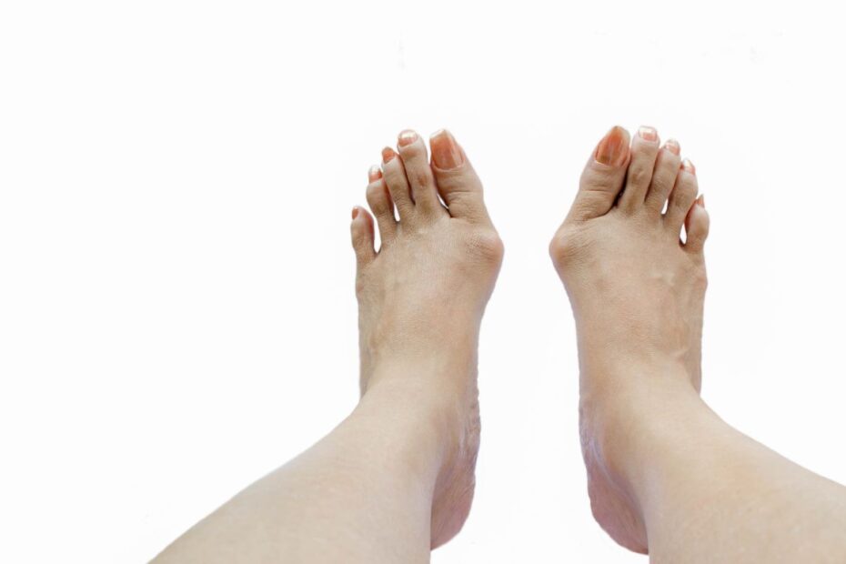 Co na bolące haluksy