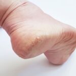 Odciski na pięcie – co je powoduje i jak je leczyć? Odciski na pięcie