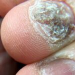 Czy grzybica paznokci jest zaraźliwa?