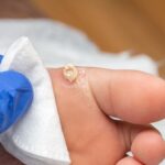 Kurzajka i odcisk na stopie