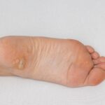 Octenisept na kurzajki