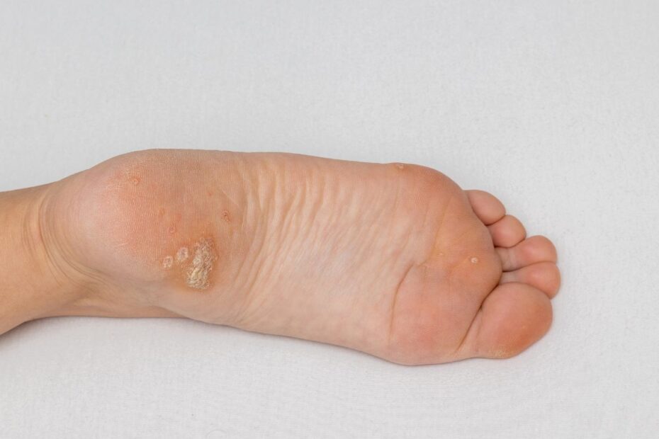 Octenisept na kurzajki