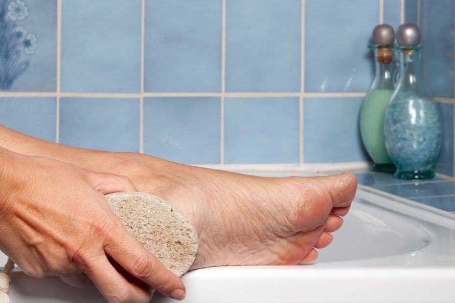 Jak pozbyć się odcisków