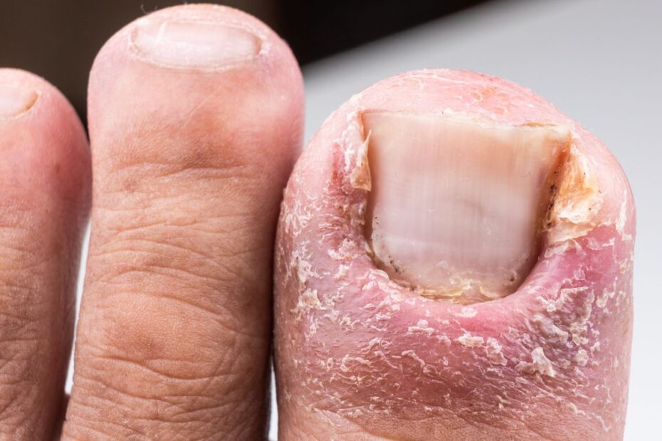 Usuwanie wrastającego paznokcia