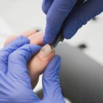 Klamra na wrastające paznokcie – jak działa i kiedy warto? Klamra na wrastające paznokcie