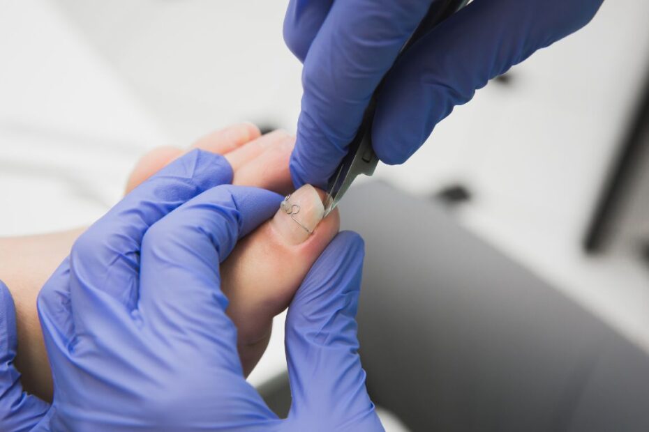 Klamra na wrastające paznokcie