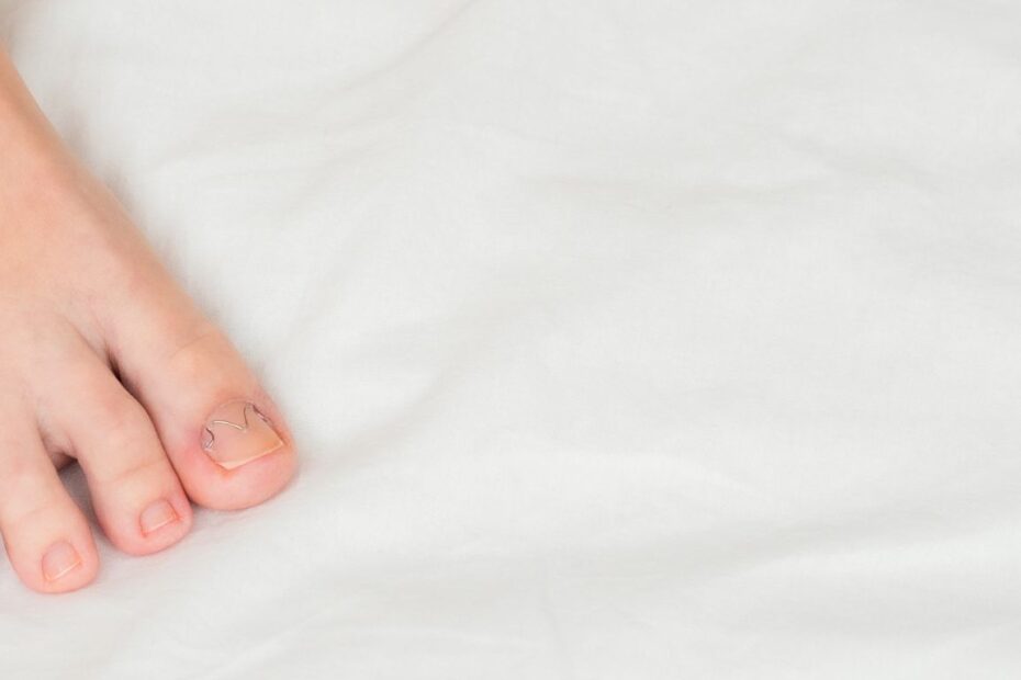 Co zrobić z wrastającym paznokciem?