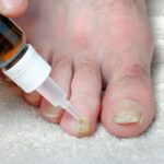 Wieloletnia grzybica paznokci – jak radzić sobie z przewlekłą infekcją Wieloletnia grzybica paznokci