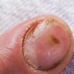 Grzybica paznokci u rąk po hybrydzie