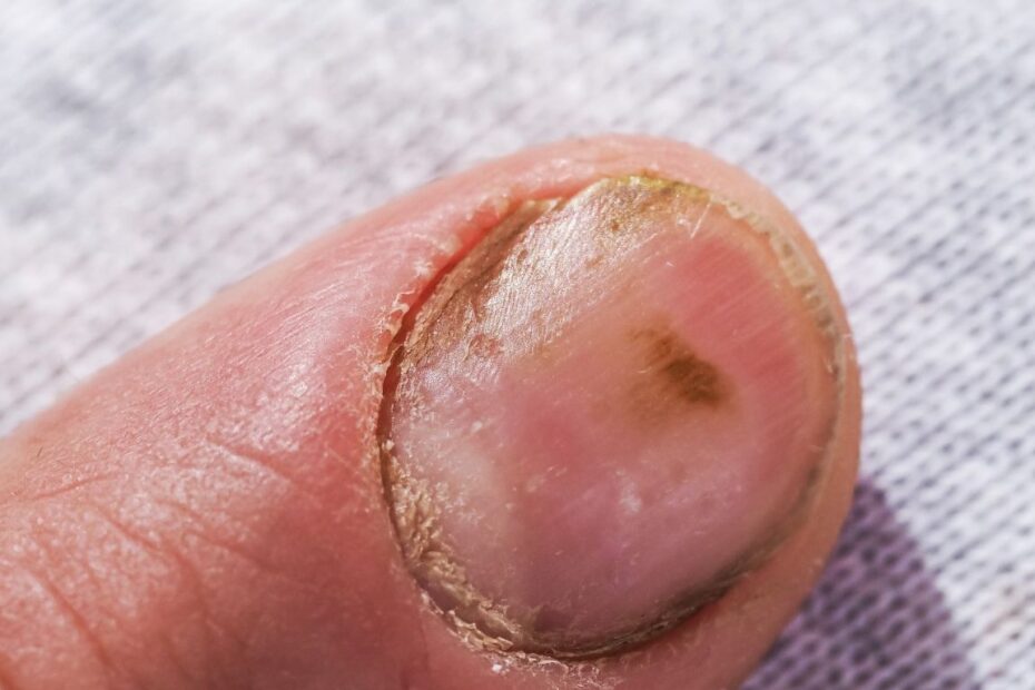 Grzybica paznokci u rąk po hybrydzie