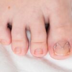 Lek na wrastające paznokcie u nóg – przegląd dostępnych opcji Lek na wrastające paznokcie u nóg