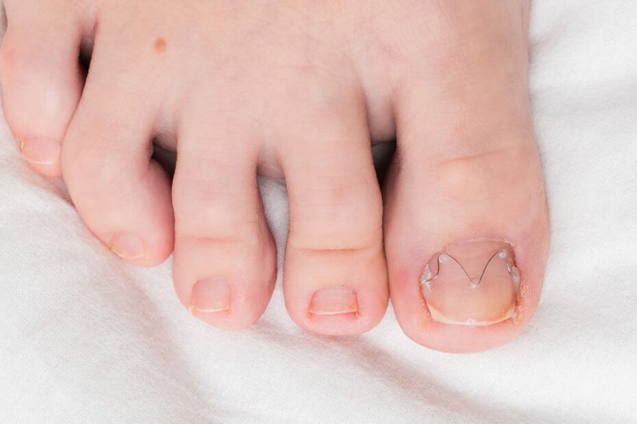 Lek na wrastające paznokcie u nóg