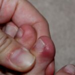 Maść na wrastające paznokcie