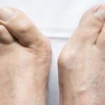 Jak zapobiegać haluksom