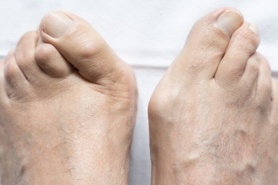 Jak zapobiegać haluksom