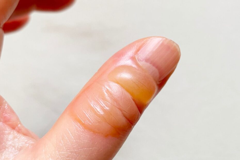 Czy przebijać odciski