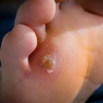 Jak pozbyć się odcisków na stopach