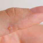 Kurzajki w ciąży – czy są niebezpieczne? Kurzajki w ciąży