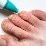 Czego boi się grzybica paznokci – skuteczne środki przeciwgrzybicze Czego boi się grzybica paznokci