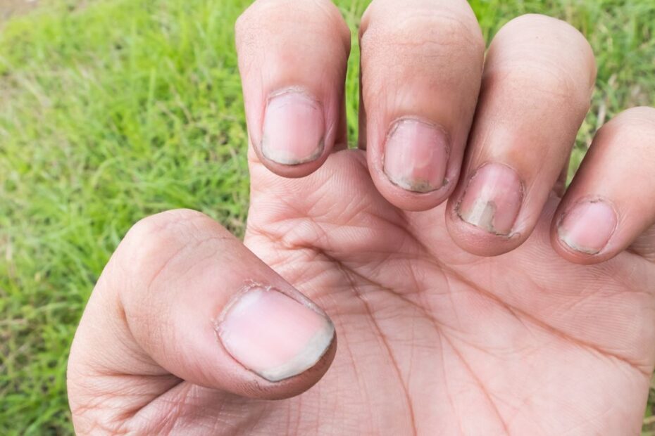 Grzybica paznokcia u rąk