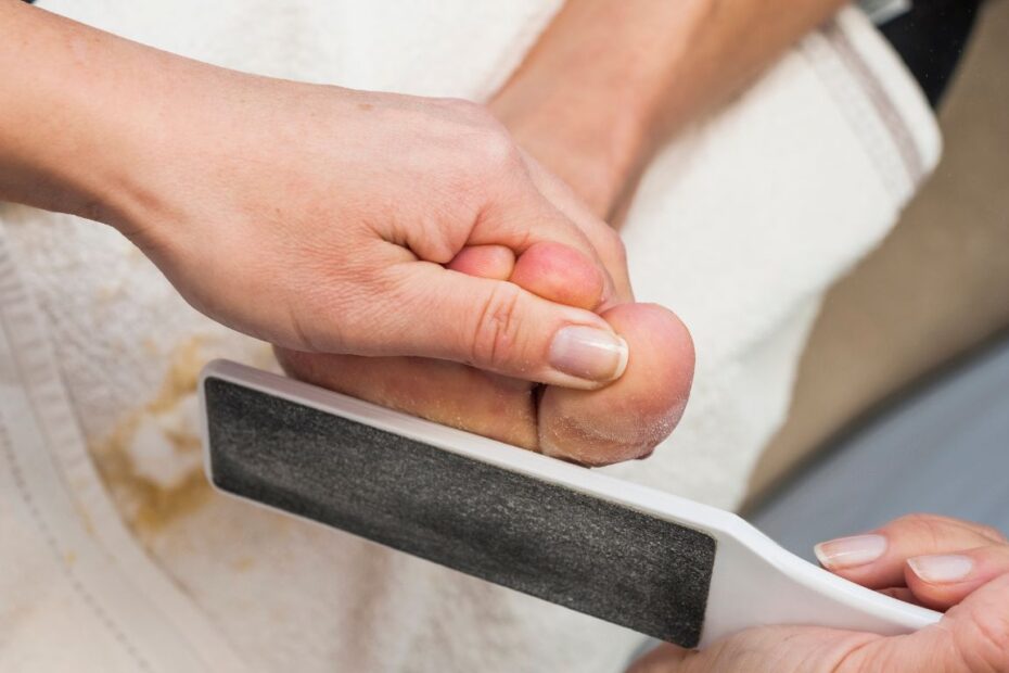 Twardy bolący odcisk na stopie