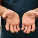 Odciski na rękach – przyczyny i leczenie Odciski na rękach