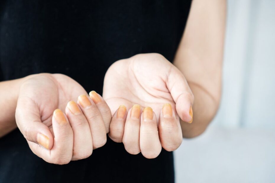 Biała grzybica paznokci