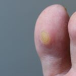 Odciski na dużym palcu – jak je usunąć i jak im zapobiegać? Odciski na dużym palcu