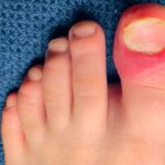 Domowe sposoby na wrastający paznokieć