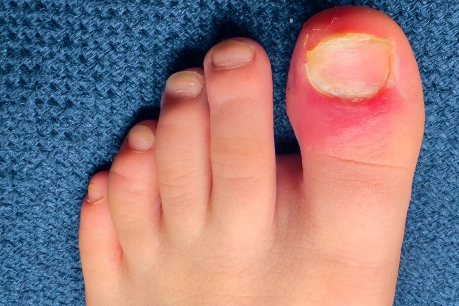 Domowe sposoby na wrastający paznokieć