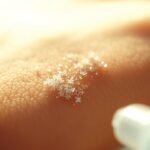 Azotan srebra na kurzajki