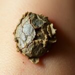 Kiedy kurzajka umiera – przebieg naturalnego leczenia Kiedy kurzajka umiera