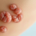 Od czego robi się kurzajka – przyczyny i czynniki ryzyka Od czego robi się kurzajka