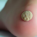 Rana po kurzajce – jak ją pielęgnować? Rana po kurzajce