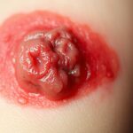 Stan zapalny wokół kurzajki – jak sobie radzić? Stan zapalny wokół kurzajki