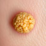 Verrumal na kurzajki